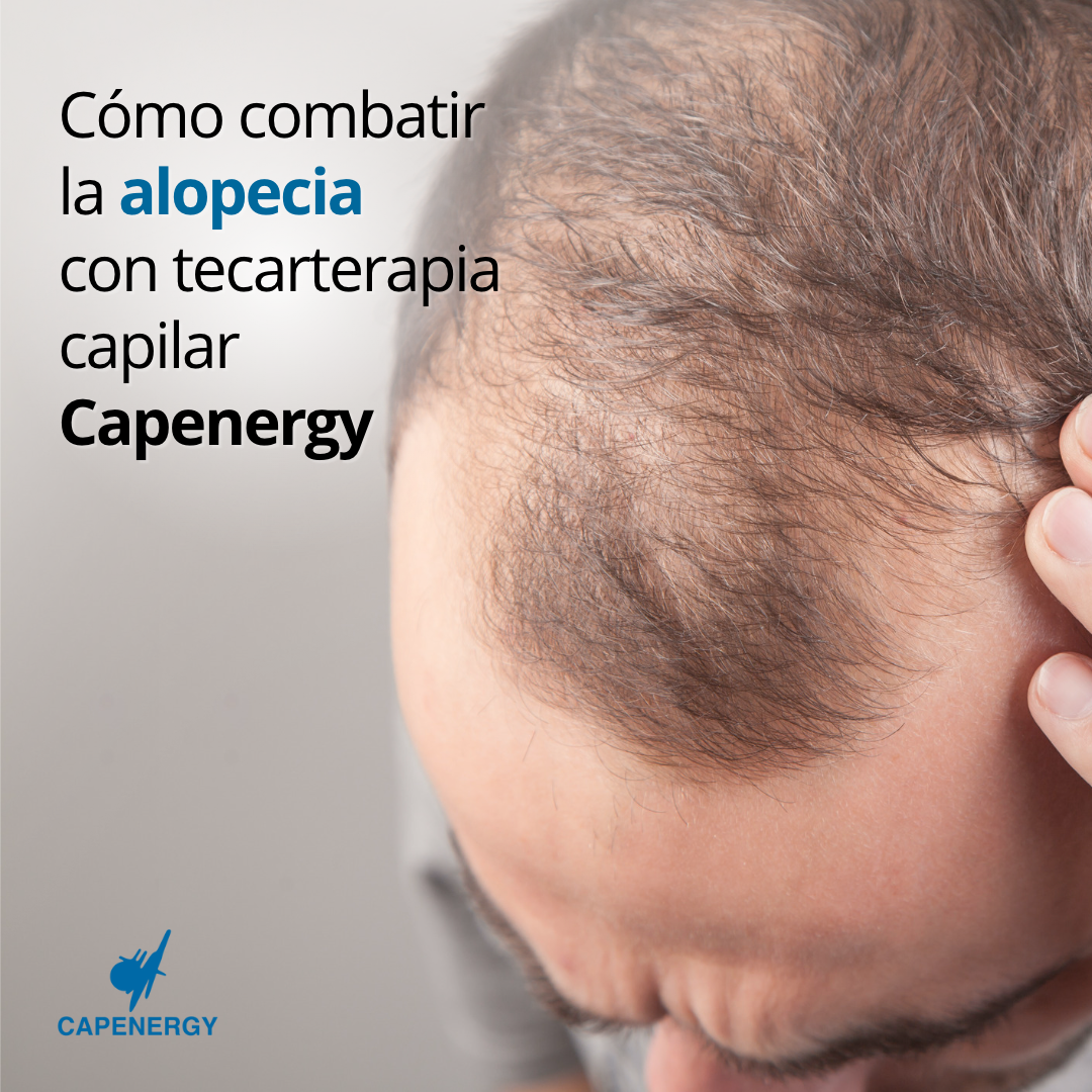 Cómo tratar la alopecia con tecarterapia Capenergy