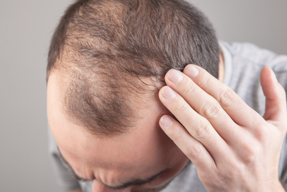 Cómo combatir la alopecia con tecarterapia capilar Capenergy