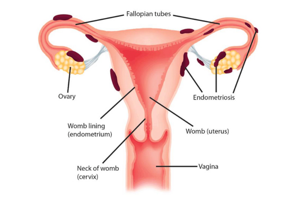 Endometriosis, una patología desconocida y silenciosa