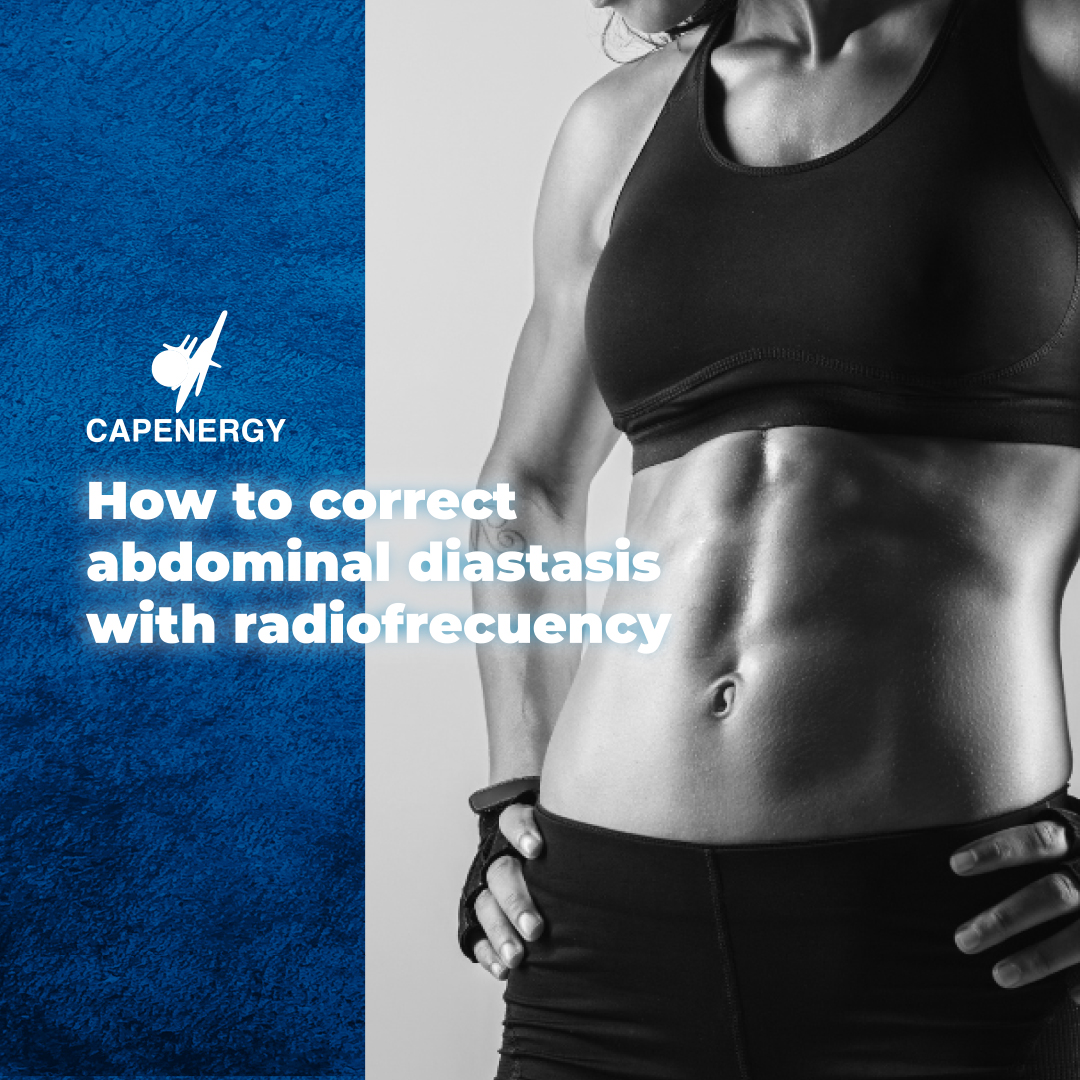 How to correct abdominal diastasis with radiofrecuency