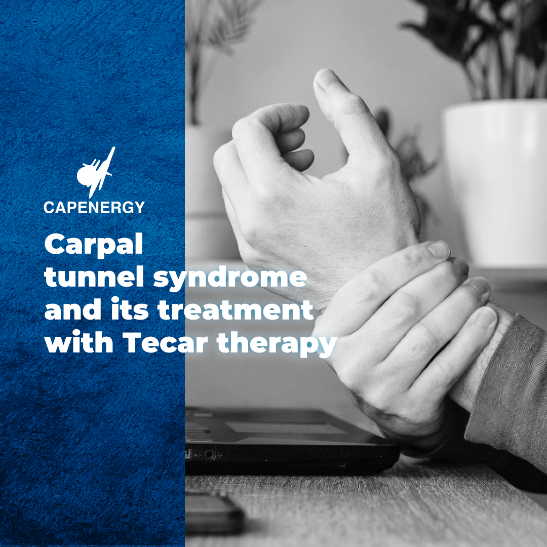 Carpal tunnel syndrome and its treatment with tecar therapy - Capenergy