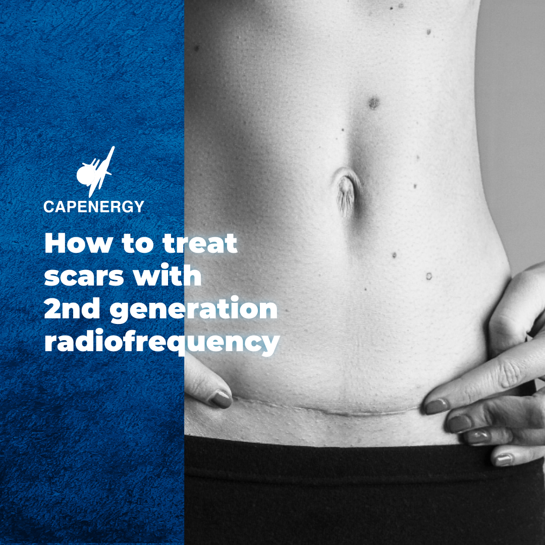 Treatment scars with Capenergy radiofrequency