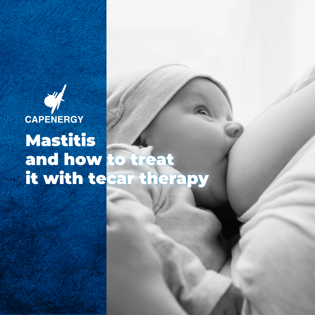 Mastitis and how to treat it with tecar therapy