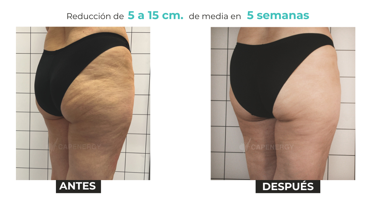 Comparativa antes y después de celulitis en protocolo profesional de radiofrecuencia Capenergy