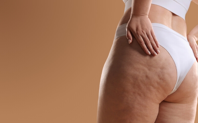 Tratamiento celulitis radiofrecuencia en medicina estética profesional