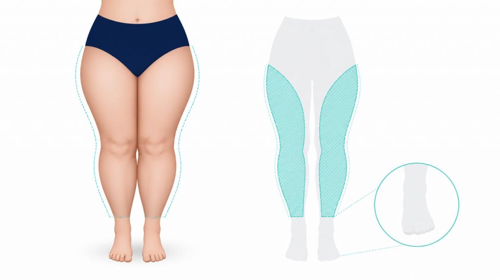 Diferencias entre lipedema, obesidad y linfedema en las piernas
